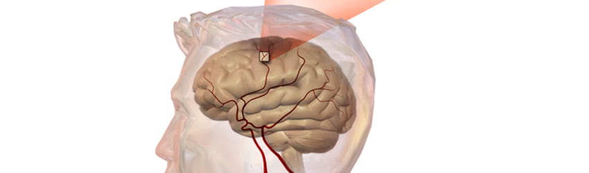 Cerebrovascular accident 